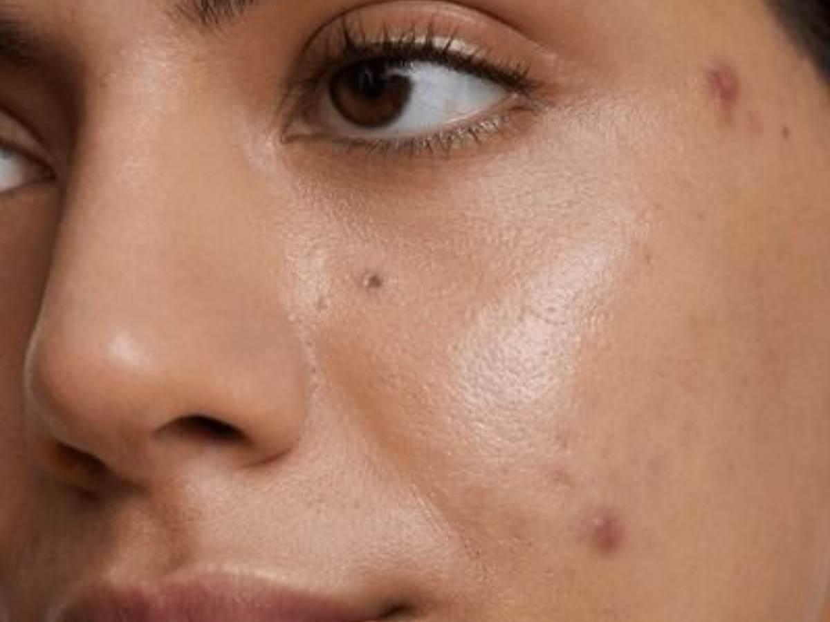 Acne