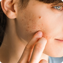 Acne